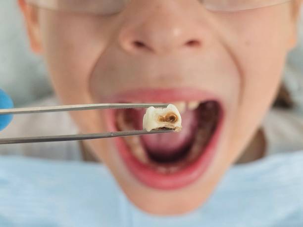 Best Knocked-Out Tooth (Avulsed Tooth) Treatment in Hightstown, NJ